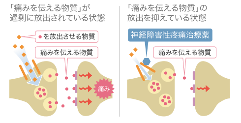 神経障害性疼痛治療薬を投与のイメージ